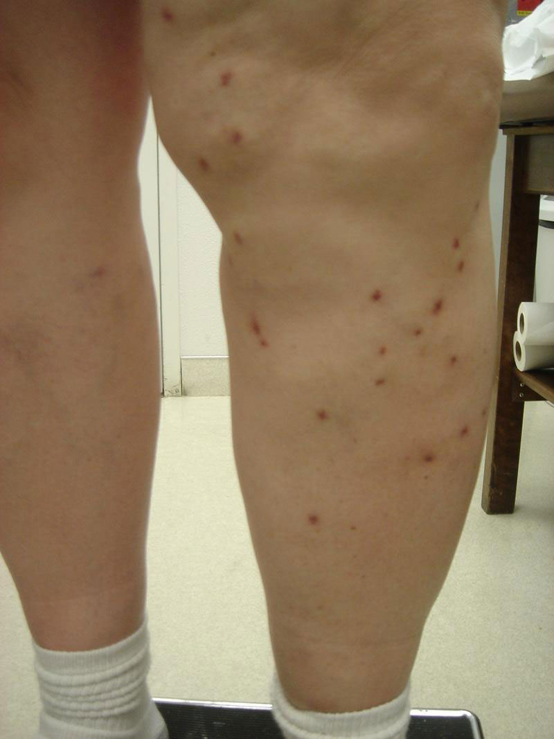 Varicose Veins right after treatment
