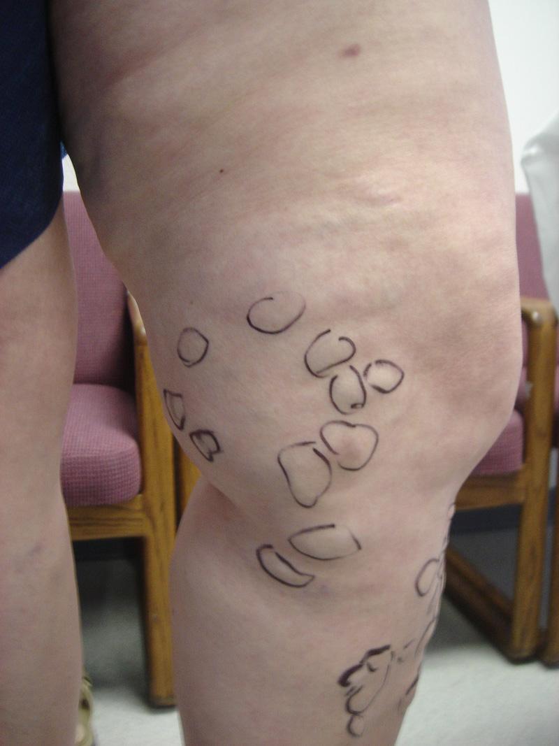 Varicose Veins consult for treatment