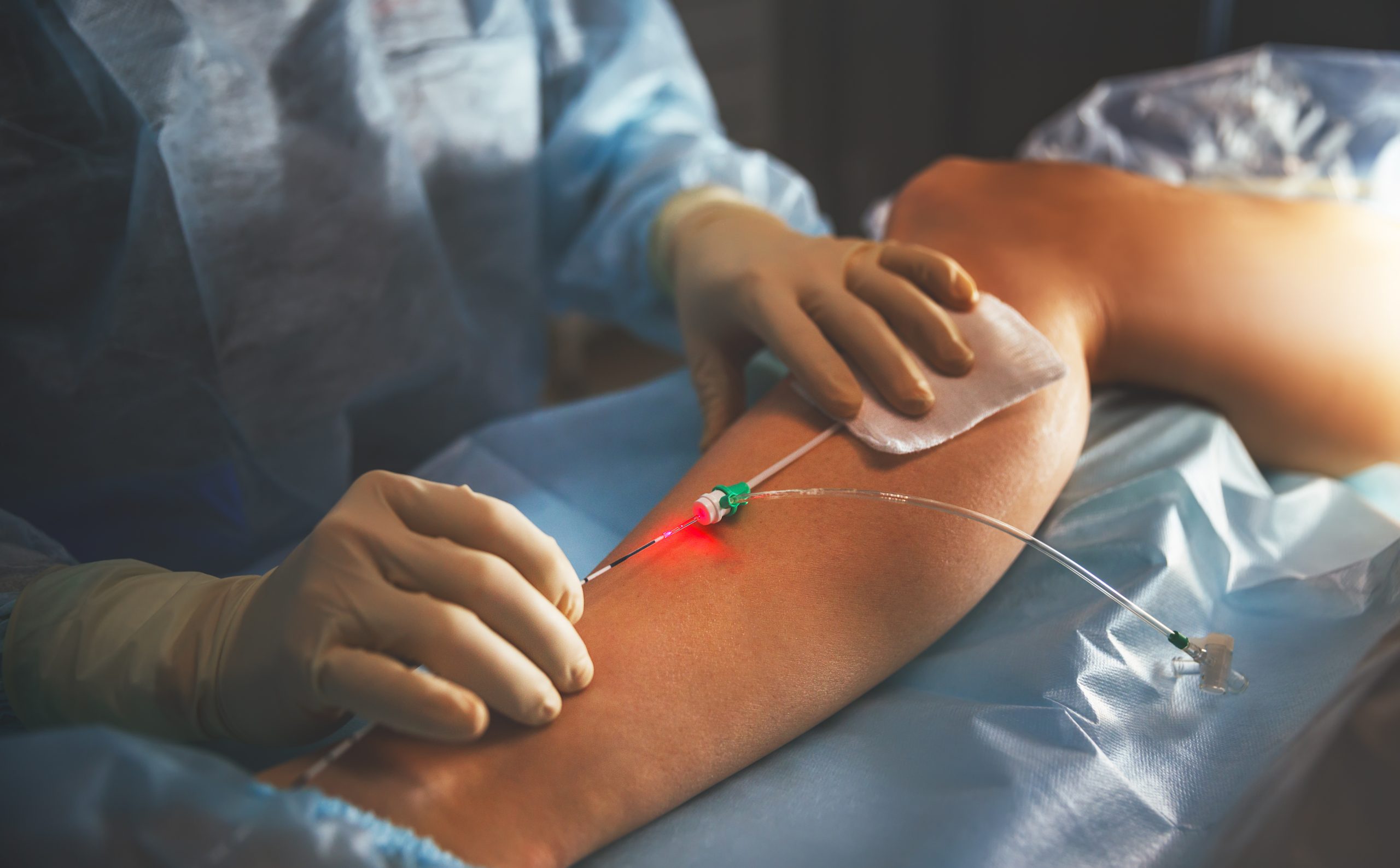 Minimally Invasive Vein Surgery for Varicose Veins laser ablation