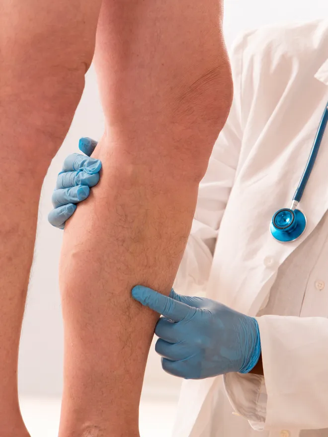 Diagnosis of Vein Disease spider veins
