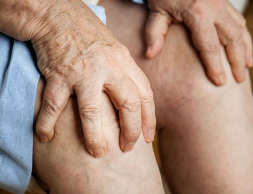 Understanding the Interplay Between Stress and Varicose Veins